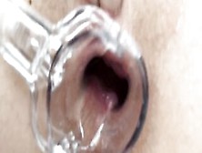 Speculum Inside This Filthy Hoe Her Butt