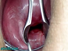 Insemination Cum Into Uterus And Endoscope Camera