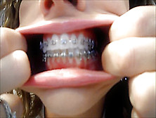 Braces Mouth Exam And Tour