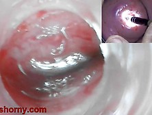 Endoscope Camera Inside Cervix Camera Into Vagina