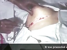 Young Italian Woman Atrial Septal Defect Closure 1
