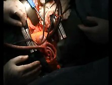 Aortic Arch Replacement French Woman