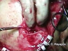 Craniofacial Resection Cystic Carcinoma