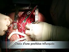 Aortic Arch Replacement Young French Woman