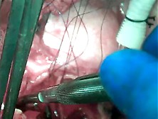 Open Thoracoabdominal Aortic Aneurysm Repair 12