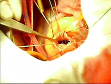 Aortic Valve Replacement Young Woman