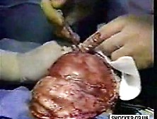 Brain Surgery Young Girl