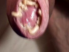 Maggot Packing Foreskin Tight And Hfo