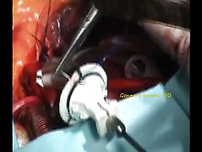 Young Italian Man Aortic Valve Replacement