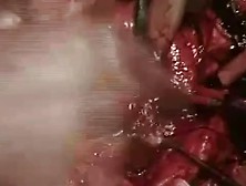 Italian Woman Cardiac Mixoma Resection Surgery