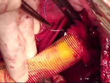 Open Thoracoabdominal Aortic Aneurysm Repair 9