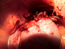 Bleeding Badly As Maggots Burrow In