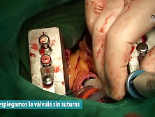 Aortic Valve Replacement Ministernotomy
