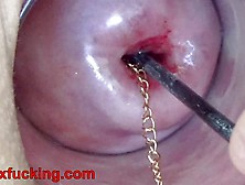Extreme Cervix Insertion Of Metal Chain In Uterus